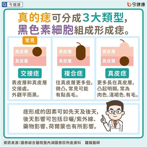 長毛痣|是痣or皮膚癌？醫「1張圖秒對照」 長這2部位最危險